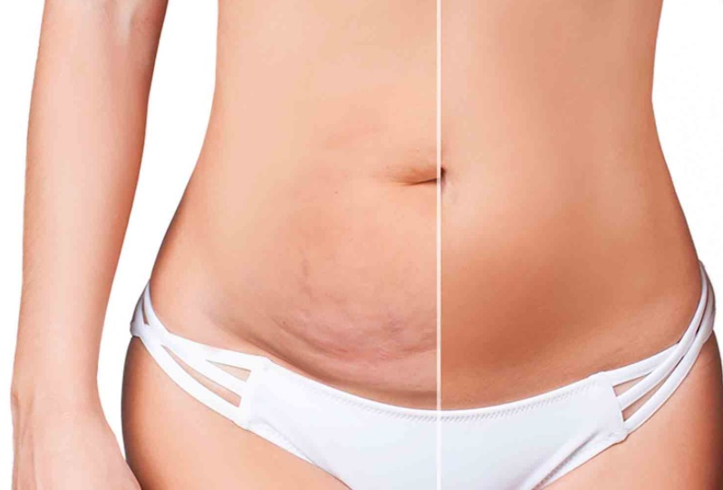 Abdominoplastie Turquie Tarif Abdominoplastie Turquie